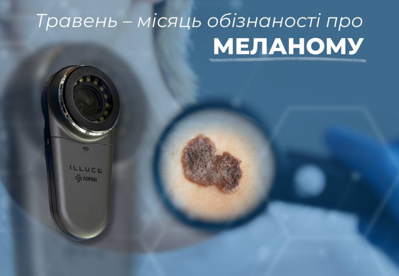 Травень: місяць обізнаності про меланому